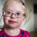 Only Person in the World with Rarest Condition is Three-Year-Old